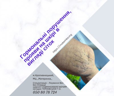 сітка гормони телеангіоектазія
