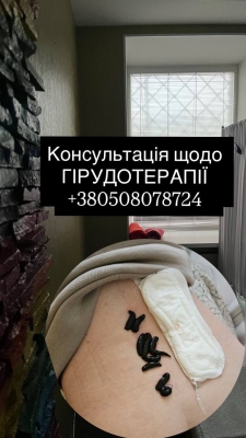 гірудотерапія при гіпертонії Кропивницький, п’явки і тиск, лікування гіпертонії комплексно, гірудин дія на кров, покращення мікроциркуляції, венозний застій лікування, натуральні методи при гіпертонії, медичні п’явки Материнка, консультація лікаря Кропивницький, лікування без перебільшень