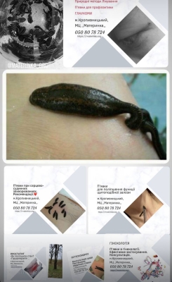 протипоказання гірудотерапія Кропивницький, медичні п’явки безпека, консультація гірудотерапевта, коли не можна п’явки, підготовка до гірудотерапії, ризики лікування п’явками, безпечне застосування гірудотерапії, курс лікування п’явками, комплексна терапія без операції протипоказання гірудотерапія Кропивницький, медичні п’явки безпека, консультація гірудотерапевта, коли не можна п’явки, підготовка до гірудотерапії, ризики лікування п’явками, безпечне застосування гірудотерапії, курс лікування п’явками, комплексна терапія без операції