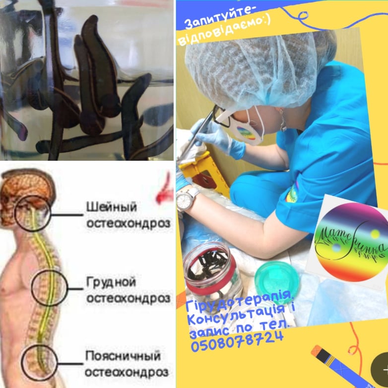 гірудотерапія гінекологія Кропивницький, п’явки при запаленні малого таза, застій крові в малому тазу лікування, болісні менструації лікування, жіноче здоров’я Кропивницький, лікування спайок, натуральна терапія гінекологія, медичні п’явки Материнка, консультація гінеколога Кропивницький, комплексне лікування без операції