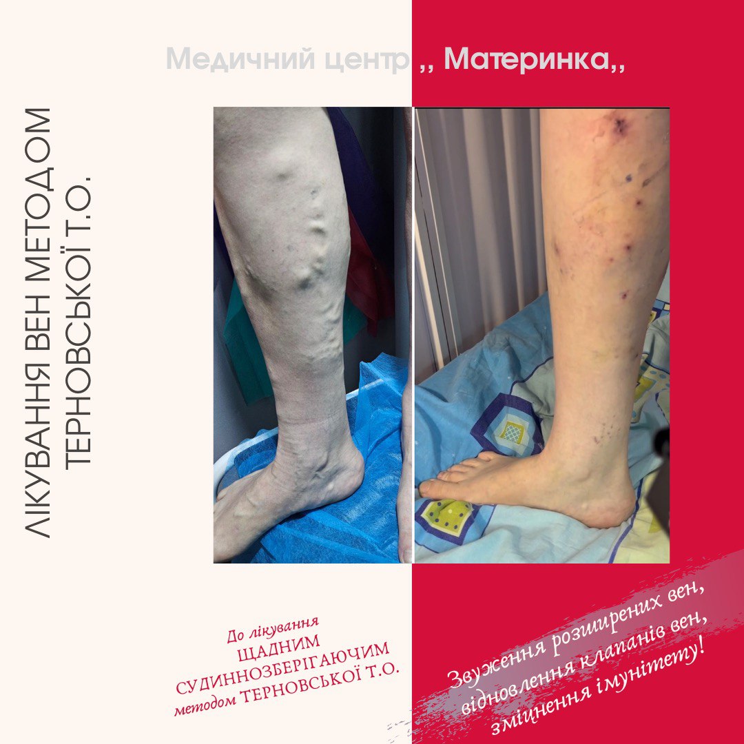 флеболог, варикоз, лікування вен, Кропивницький, без операції, Терновська, перекис водню, ціна лікування варикозу, судиннозберігаючий метод Терновської, консультація флеболога, лікування трофічних виразок.