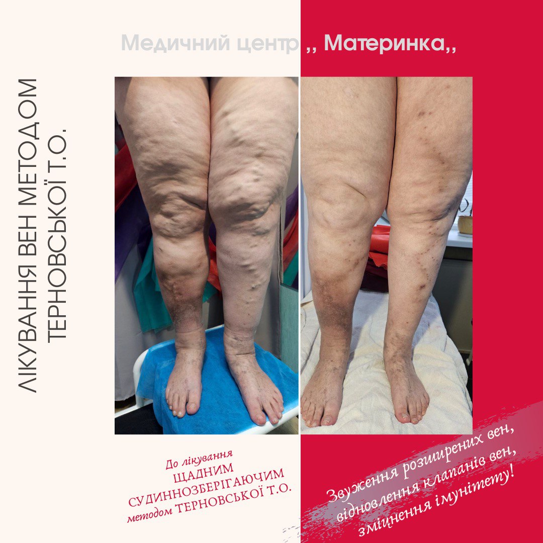 флеболог, варикоз, лікування вен, Кропивницький, без операції, Терновська, перекис водню, ціна лікування варикозу, судиннозберігаючий метод Терновської, консультація флеболога, лікування трофічних виразок