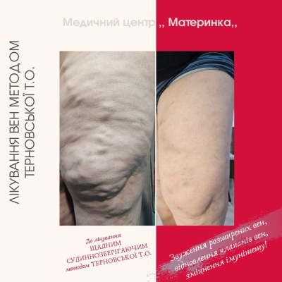 флеболог, варикоз, тромбофлебіт, лікування вен, Кропивницький, без операції, Терновська, перекис водню, судиннозберігаючий метод Терновської, консультація флеболога, лікування трофічних виразок