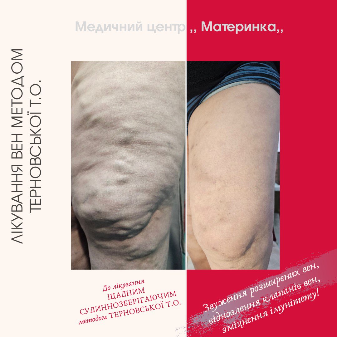 флеболог, варикоз, тромбофлебіт, лікування вен, Кропивницький, без операції, Терновська, перекис водню, судиннозберігаючий метод Терновської, консультація флеболога, лікування трофічних виразок