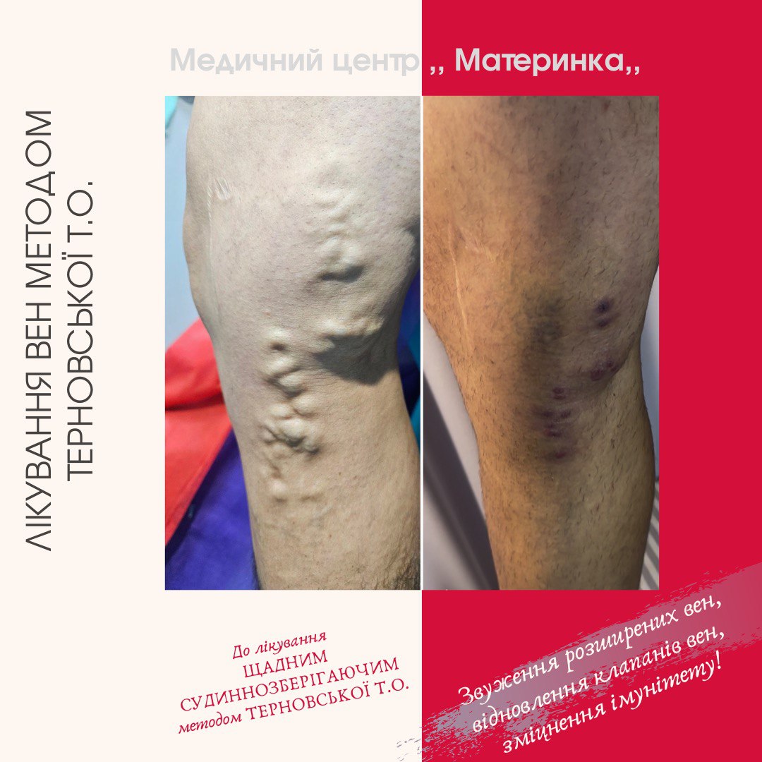 варикоз, вени, судинна сітка, набряки, тромбоз, трофічні виразки, флеболог, судиннозберігаюче лікування, кровообіг, Кропивницький.