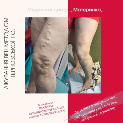 флеболог, варикоз, лікування вен, Кропивницький, без операції, Терновська, перекис водню при лікуванні вен, ціна лікування варикозу