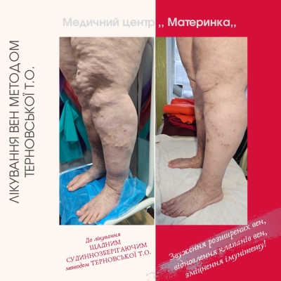 флеболог, варикоз, лікування вен, Кропивницький, без операції, Терновська, перекис водню, ціна лікування варикозу, судиннозберігаючий метод Терновської, лікування трофічних виразок, консультація флеболога.