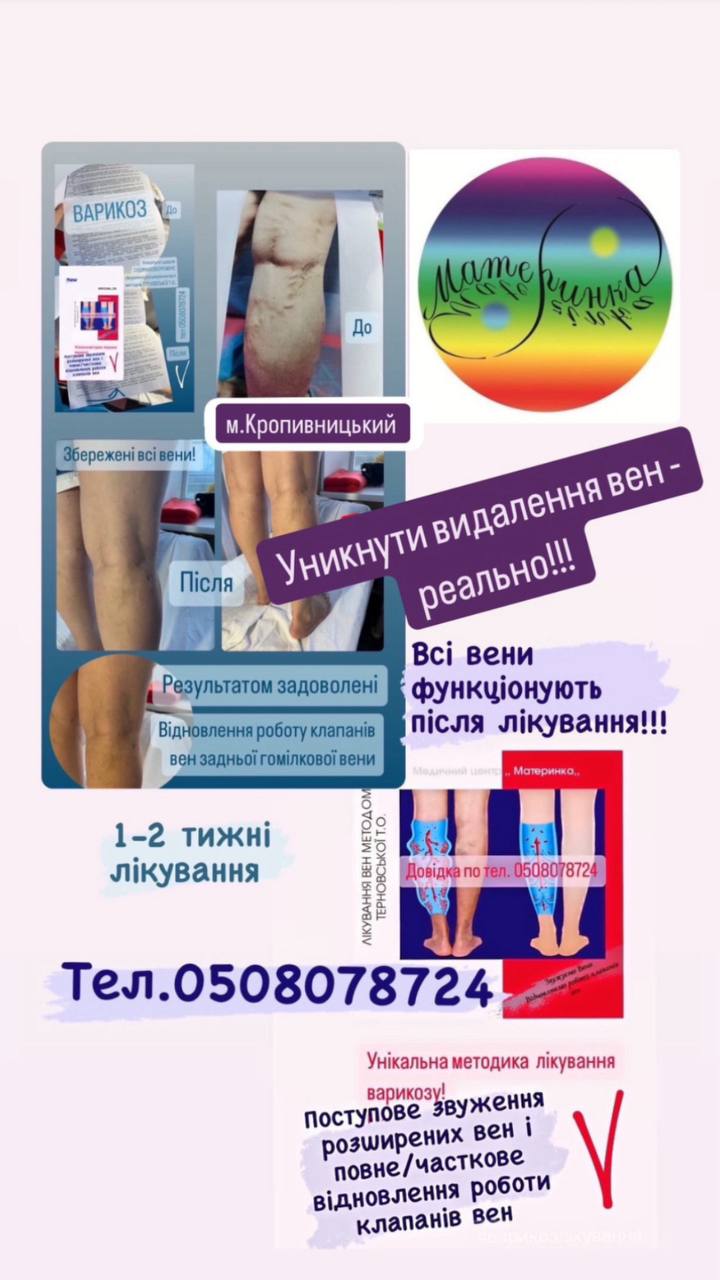 варикоз не вирок для людей із стоячою і сидячою роботою